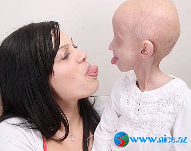 80 yaşlı insana bənzəyən 8 yaşlı qız