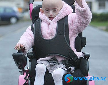 80 yaşlı insana bənzəyən 8 yaşlı qız